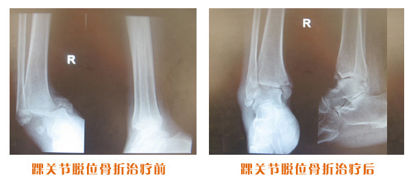 踝关节脱位骨折治疗前后对比